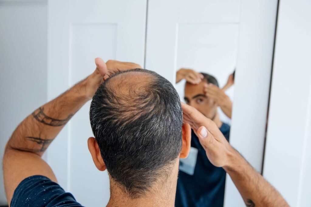 بررسی علل و روش‌های درمان ریزش مو در مردان