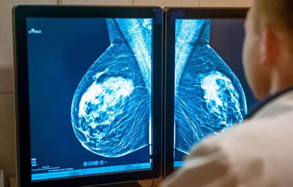 دانشمندان به پیشرفت احتمالی سرطان سینه دست یافته‌اند