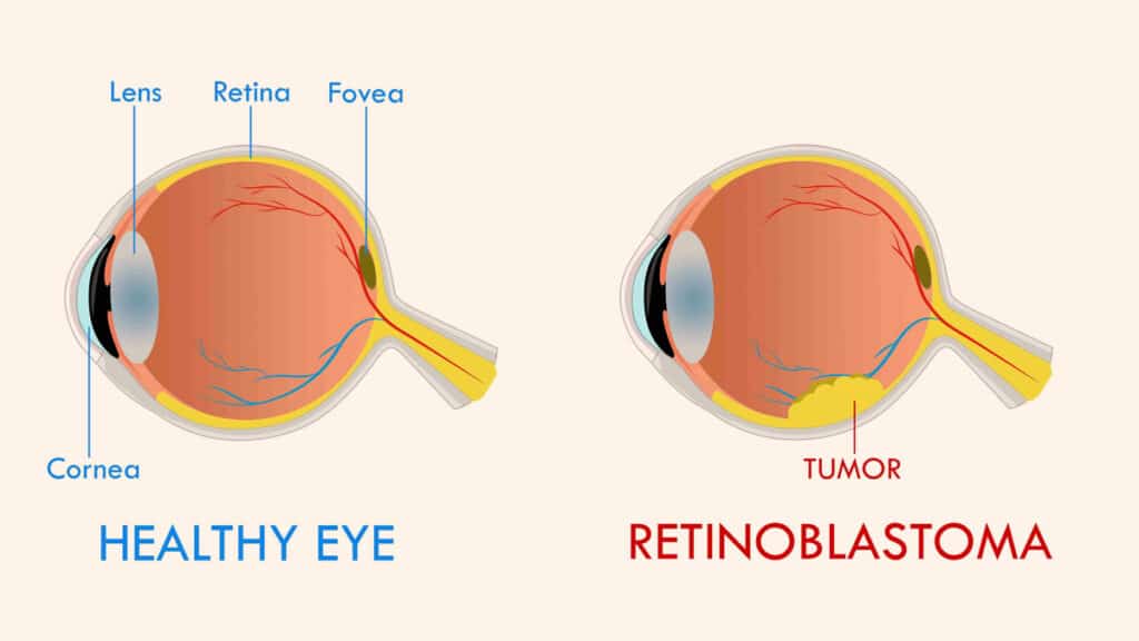 کودک یک‌ساله قربانی نادرترین سرطان چشم؛ از دست دادن بینایی در نبرد با رتینوبلاستوما