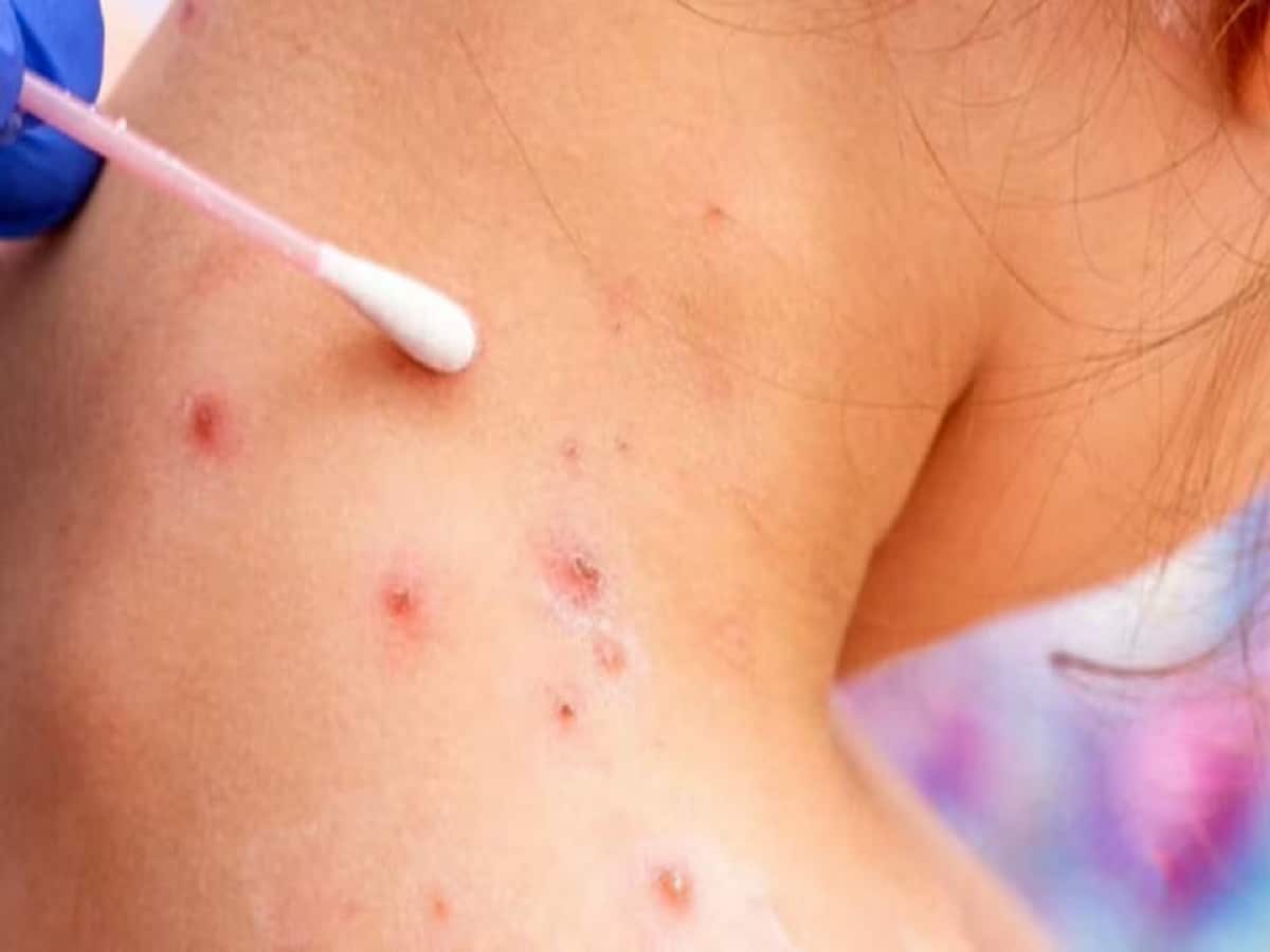 هشدار وزارت بهداشت انتاريو از ابتلا به سرخک در فروشگاه دلار