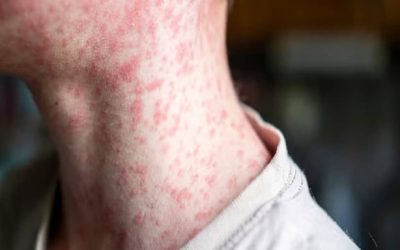 افزایش نگران‌کننده موارد سرخک در کانادا و ایالات متحده