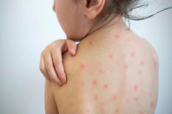 سرخک در آمريكا هم قربانی گرفت
