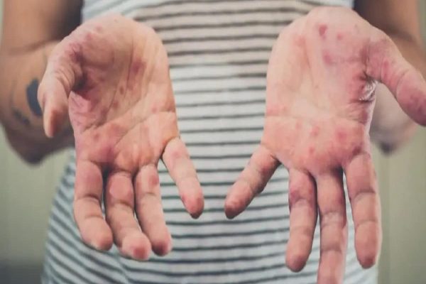 هشدار به مسافرانی كه به كانادا سفر میكنند: سرخک در يک قدمی شما كمين كرده هشدار به مسافرانی كه به كانادا سفر میكنند: سرخک در يک قدمی شما كمين كرده