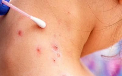 هشدار وزارت بهداشت انتاريو از ابتلا به سرخک در فروشگاه دلار