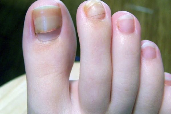 سندرم ناخن زرد چیست؟ آيا اين بيماری كشنده است؟