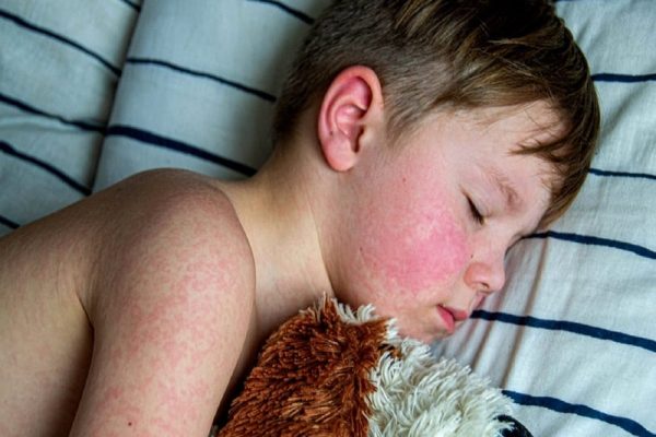 افزایش موارد سرخک در انتاریو؛ کودکان بیشتر از همه در خطر هستند افزایش موارد سرخک در انتاریو؛ کودکان بیشتر از همه در خطر هستند