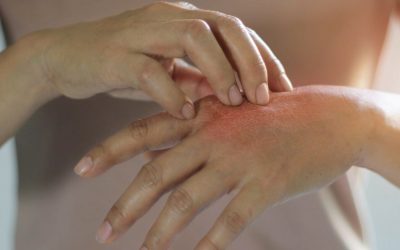 حساسیت به مواد ضدعفونی کننده