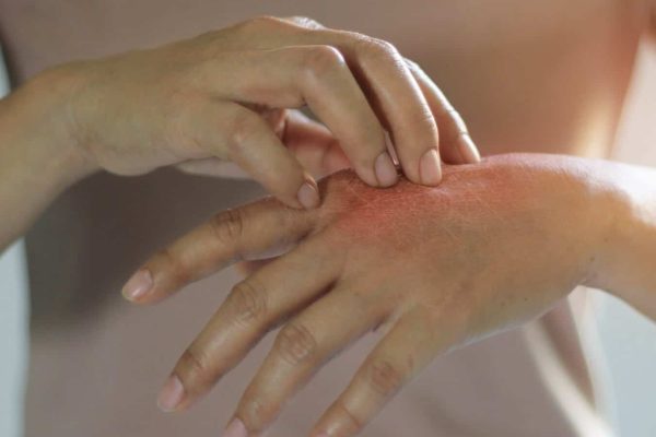 حساسیت به مواد ضدعفونی کننده