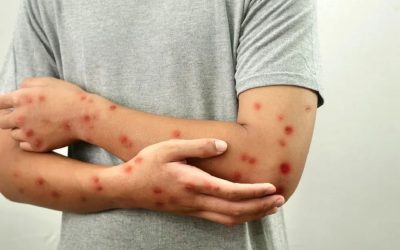 از دست رفتن وضعیت «عاری از سرخک» در کانادا