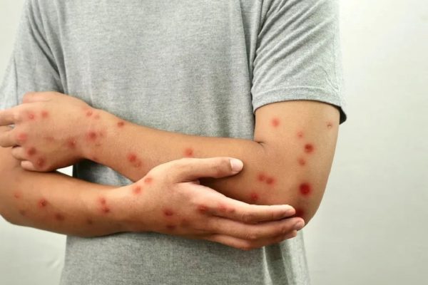 از دست رفتن وضعیت «عاری از سرخک» در کانادا